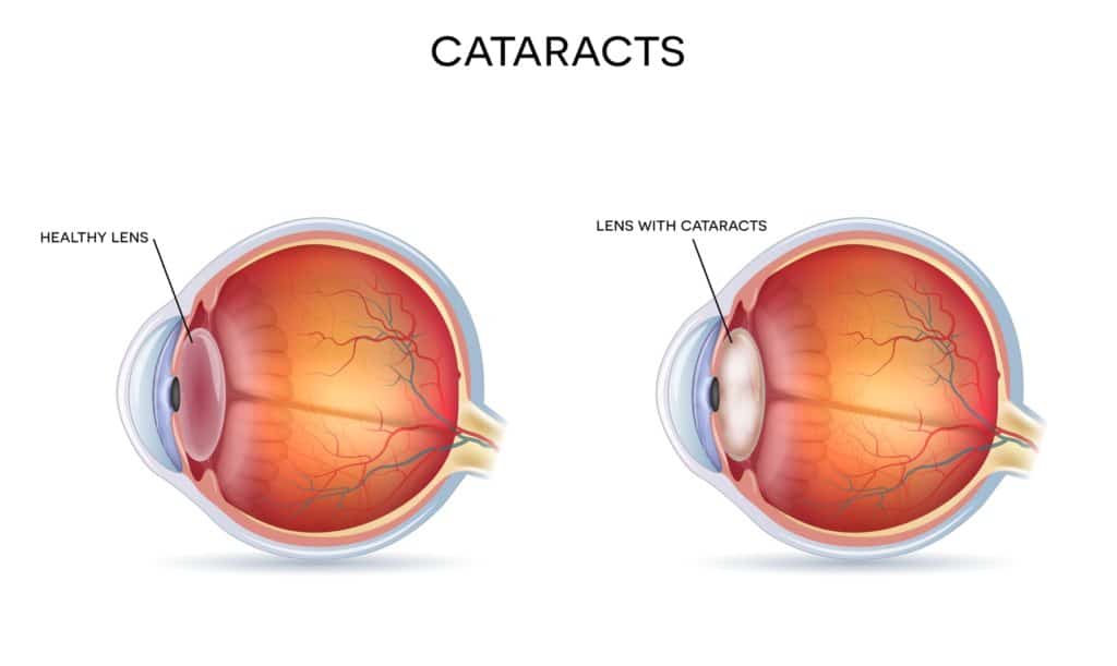 Cataract vs Healthy Eye
