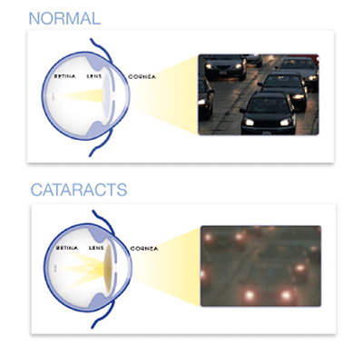 Healthy Vision vs Cataracts Vision