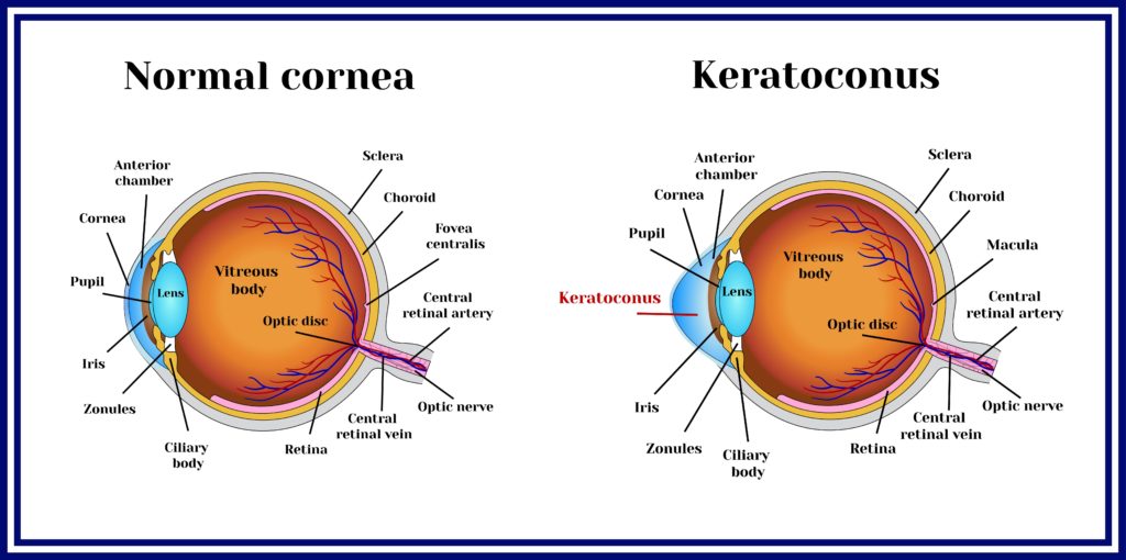 Normal Cornea vs Keratoconus