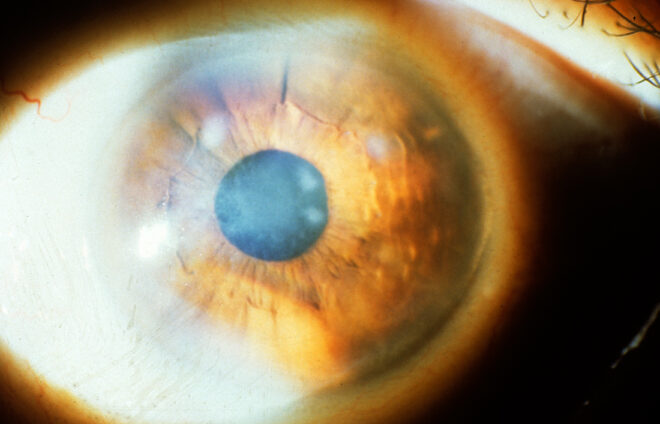 Subepithelial_mucinous_corneal_dystrophy_1