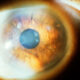 Subepithelial_mucinous_corneal_dystrophy_1