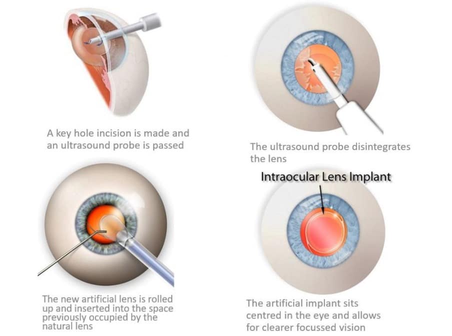 Lens Replacement