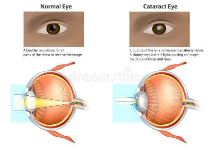 Normal Vs Cataracts Eye