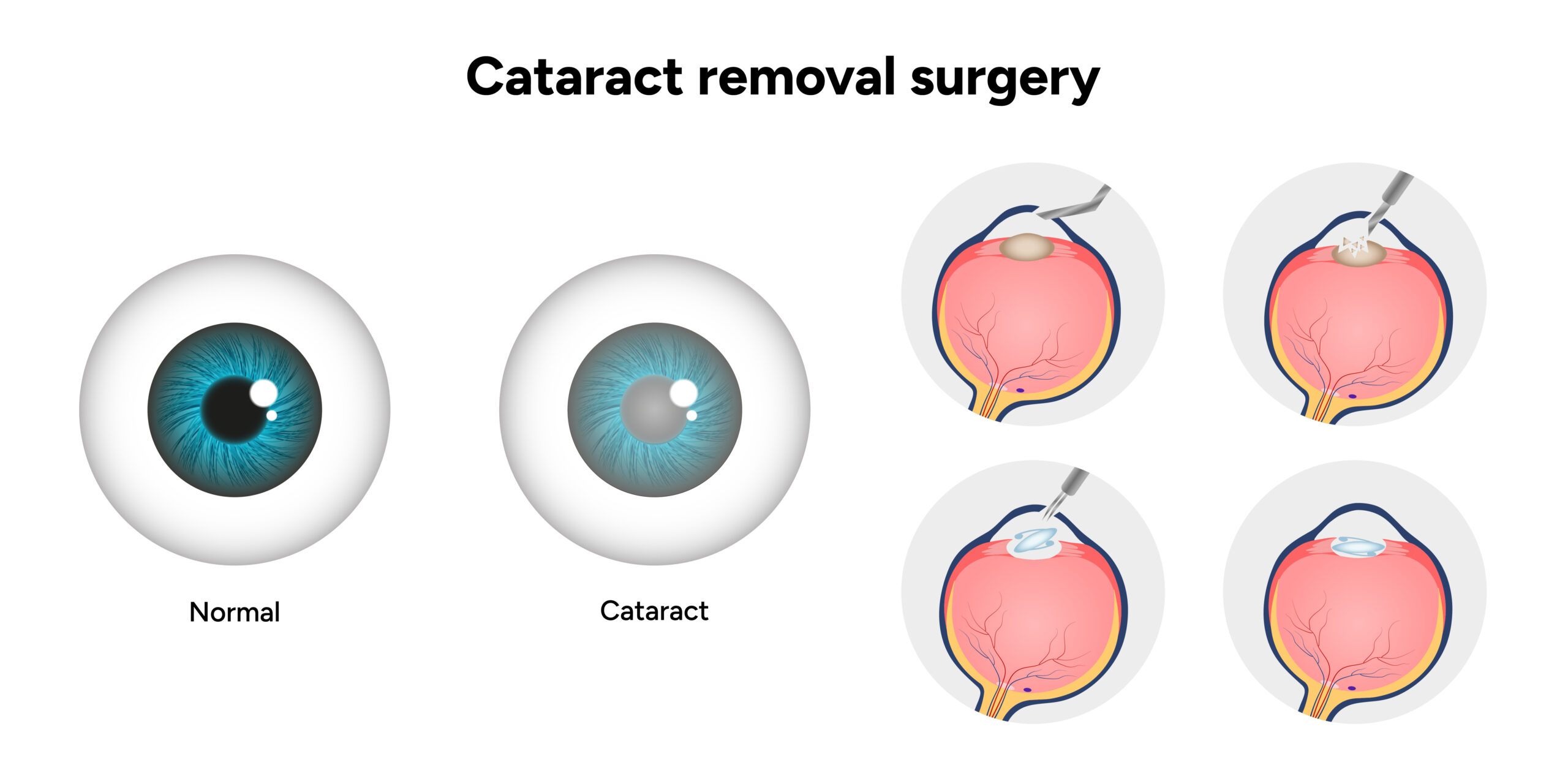 Cataract surgery removal process