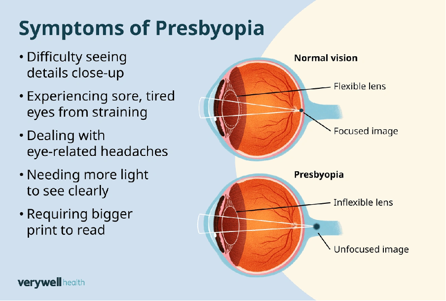 Understanding Presbyopia and Its Impact on Near Vision