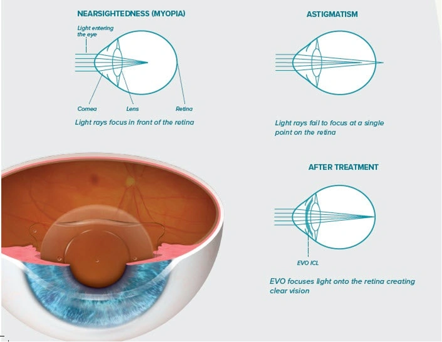 Understanding the EVO ICL Lens