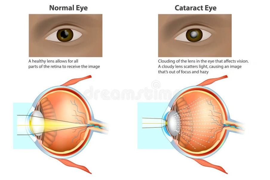 Understanding the Healing Process of cataract surgery
