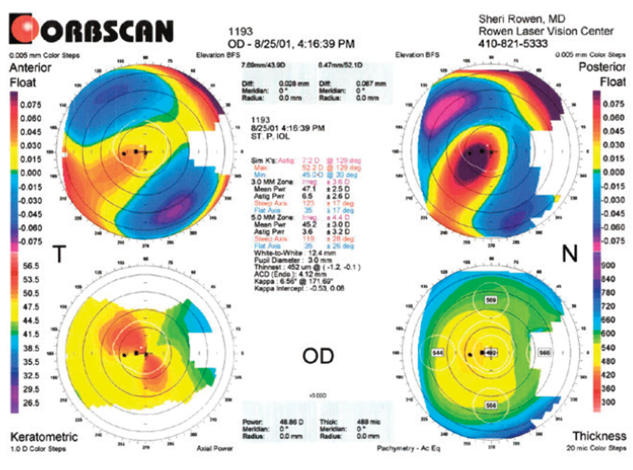 Visual Outcomes and Refractive Accuracy