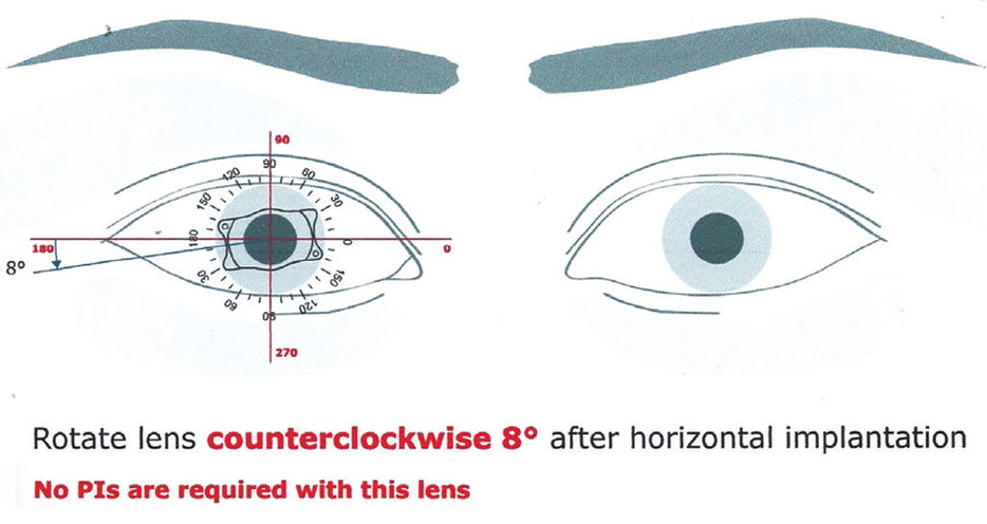 What are implantable contact lenses and how do they work