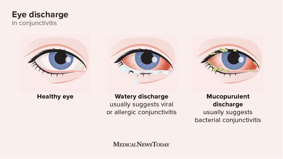 What are seasonal allergies and how do they affect the eyes?