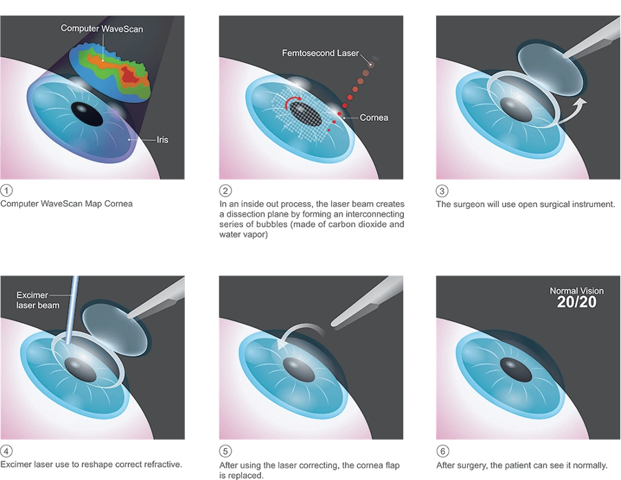 What to expect before, during and after the procedure