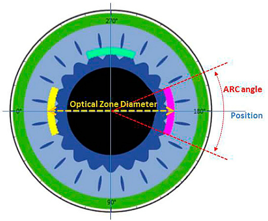 Why Astigmatism Matters During Cataract SurgeryWhy Astigmatism Matters During Cataract Surgery