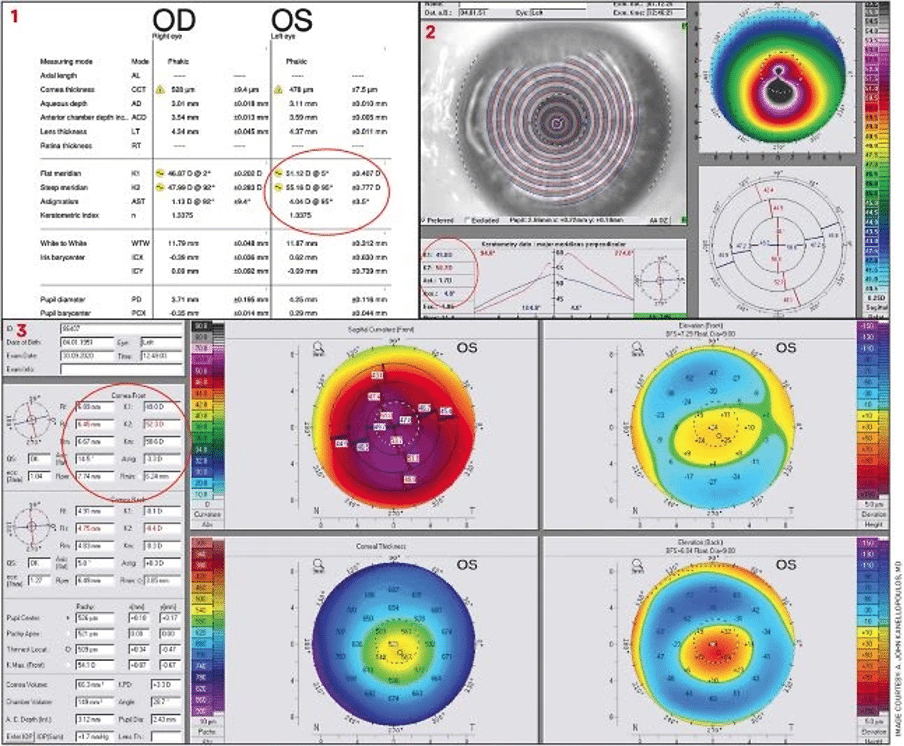 Why Cataract Surgery Matters in Keratoconus Management
