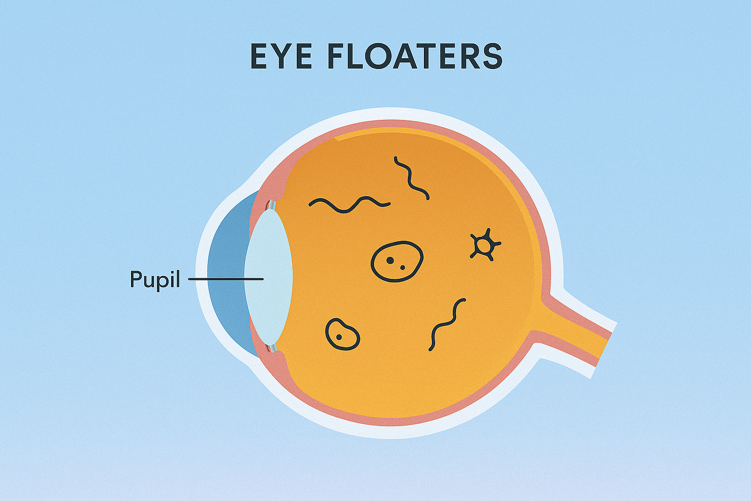 floaters in eye - cataract surgery 