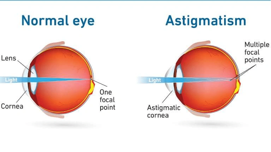 Astigmatism vs normal