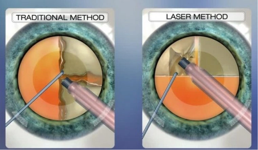 What is Refractive Cataract Surgery?