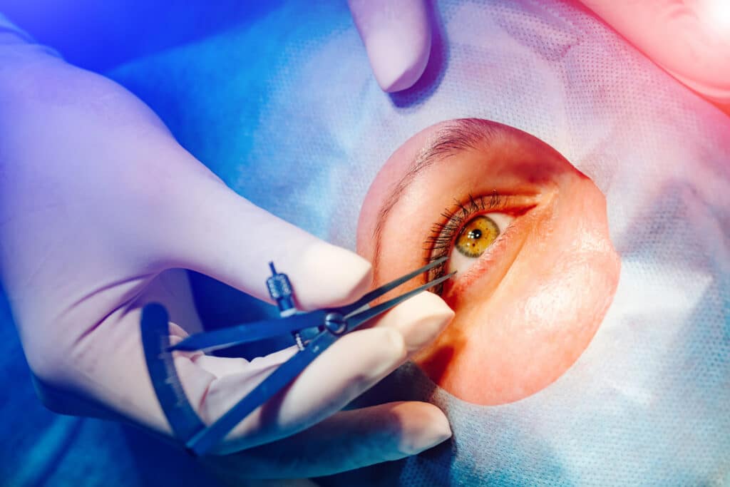 Bilateral Lens Surgery