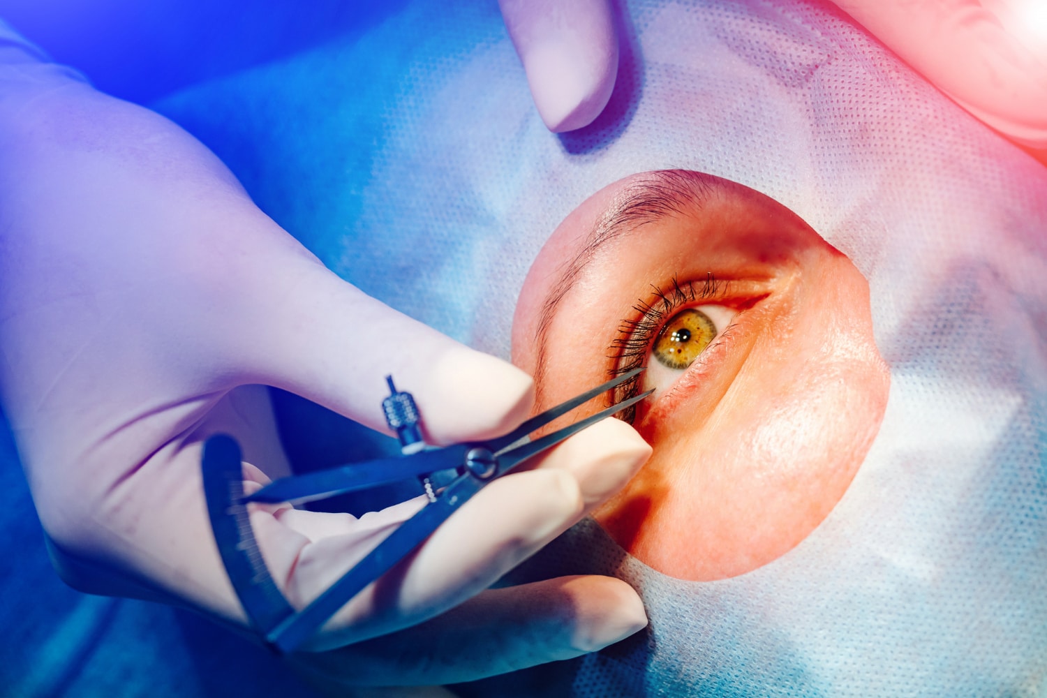 Bilateral Lens Surgery
