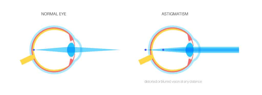How to Know If Your Astigmatism Is Back