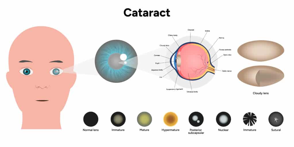 Laser vs Traditional Cataract Surgery