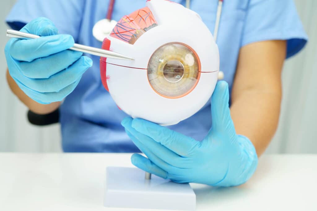 Cataracts After Implantable Lens Surgery Explained