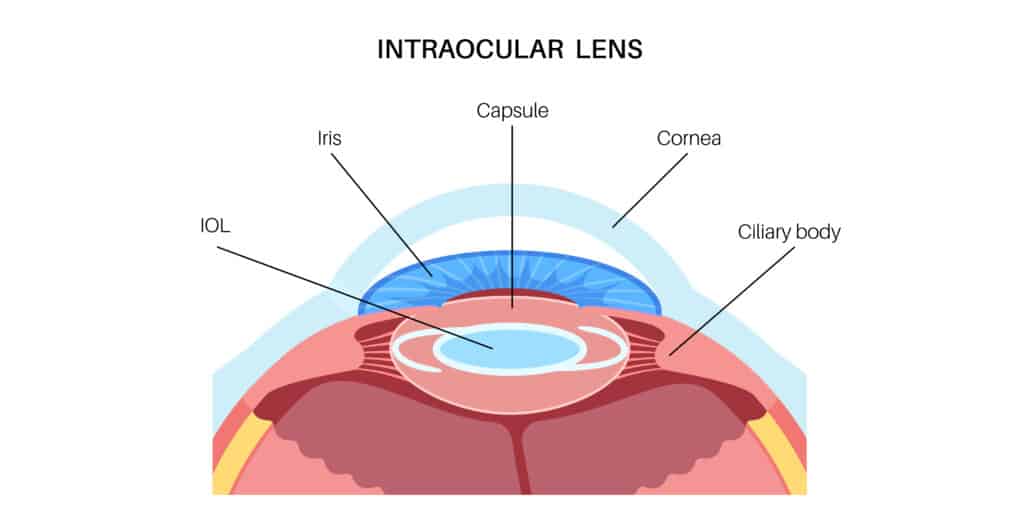 Benefits of Lens Replacement