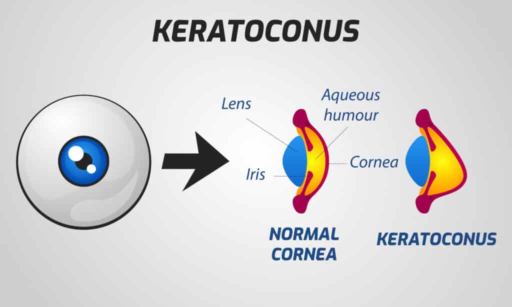 keratoconus