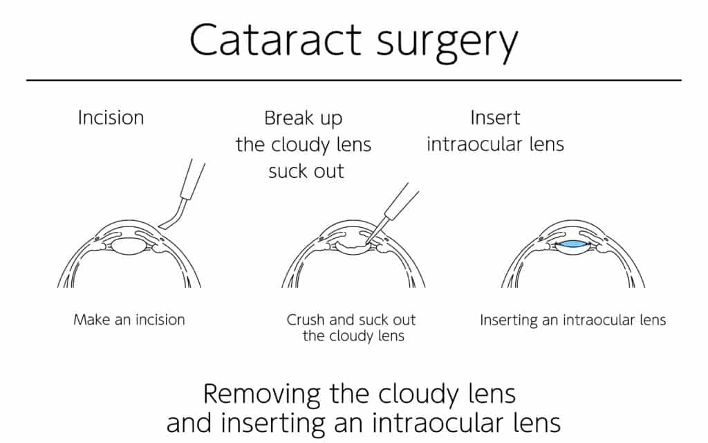 Cataract Surgery