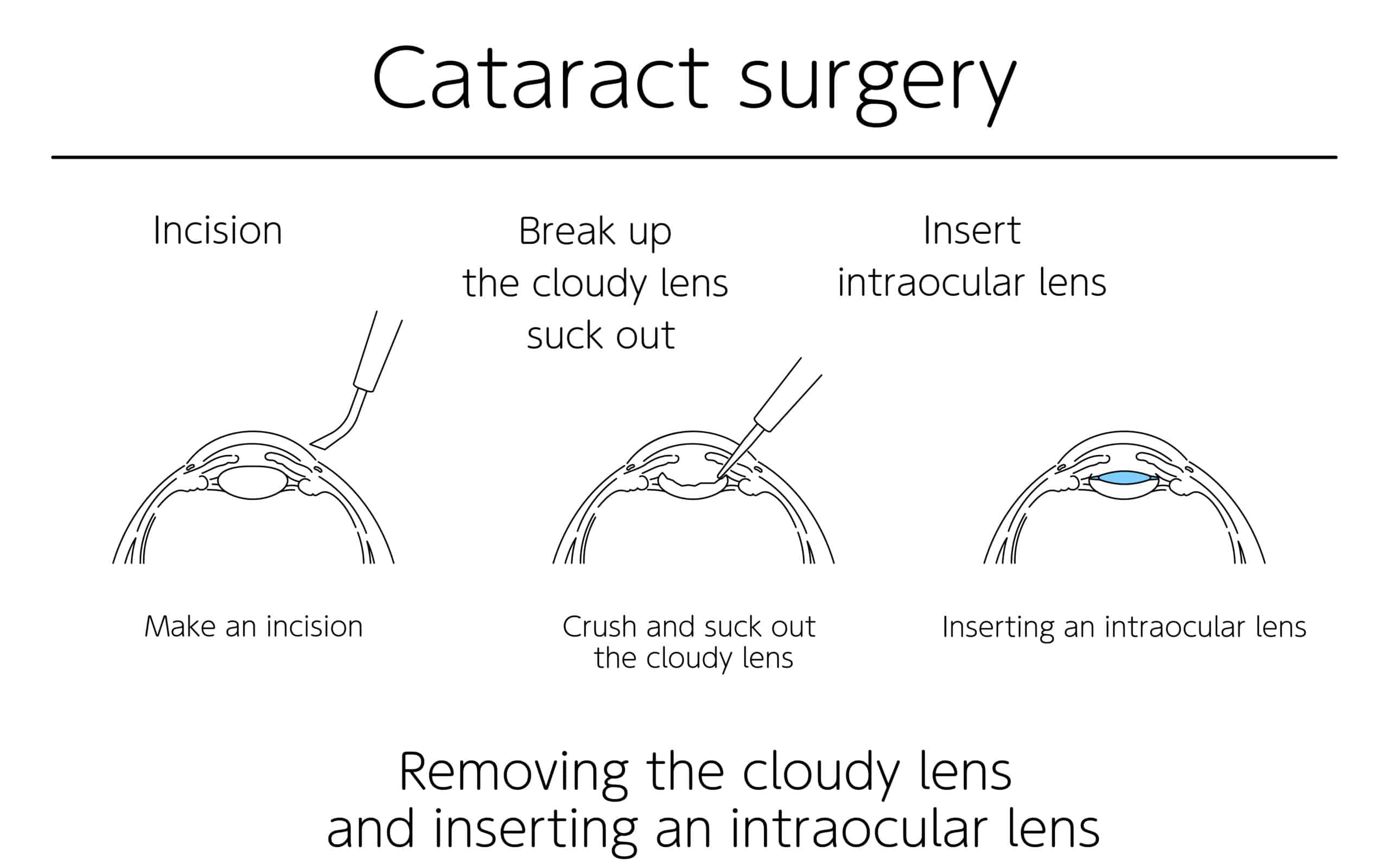 Cataract Surgery