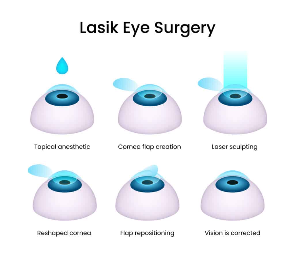 Benefits of Monovision LASIK