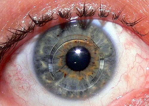 Intacs After Insertion