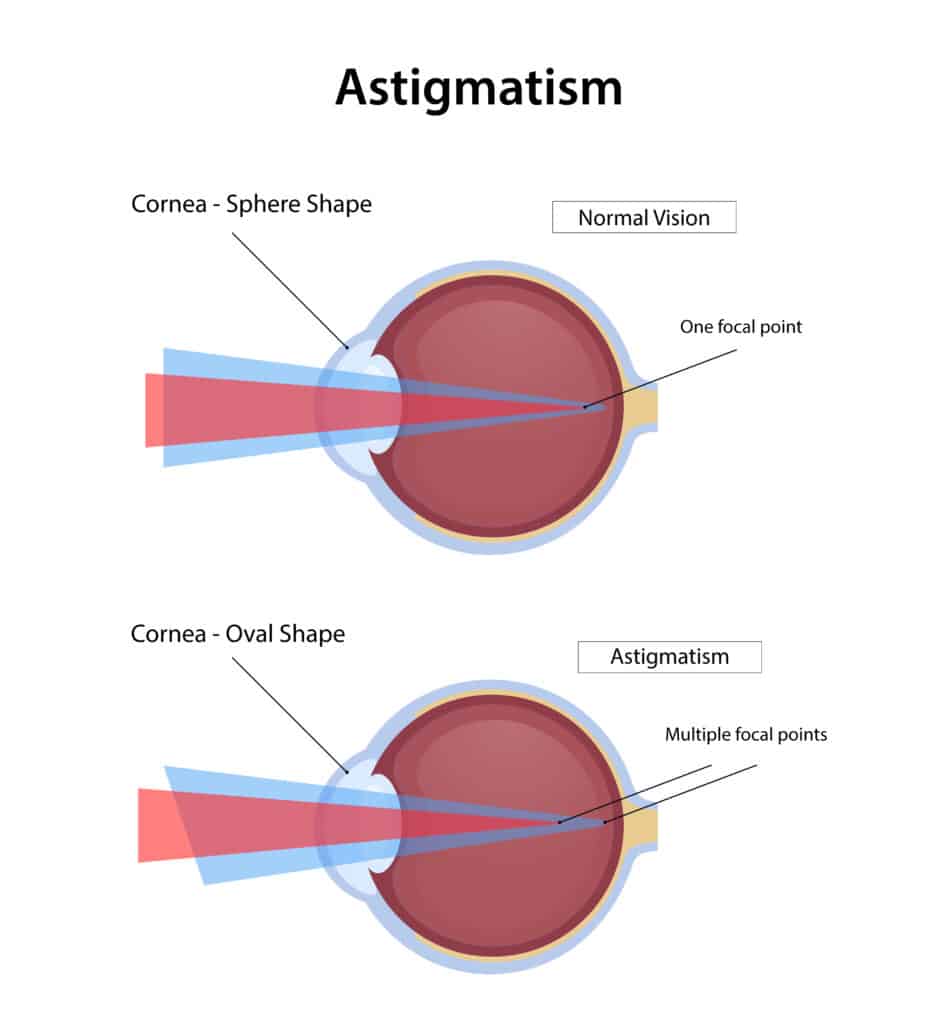 Astigmatism vs Lazy Eye