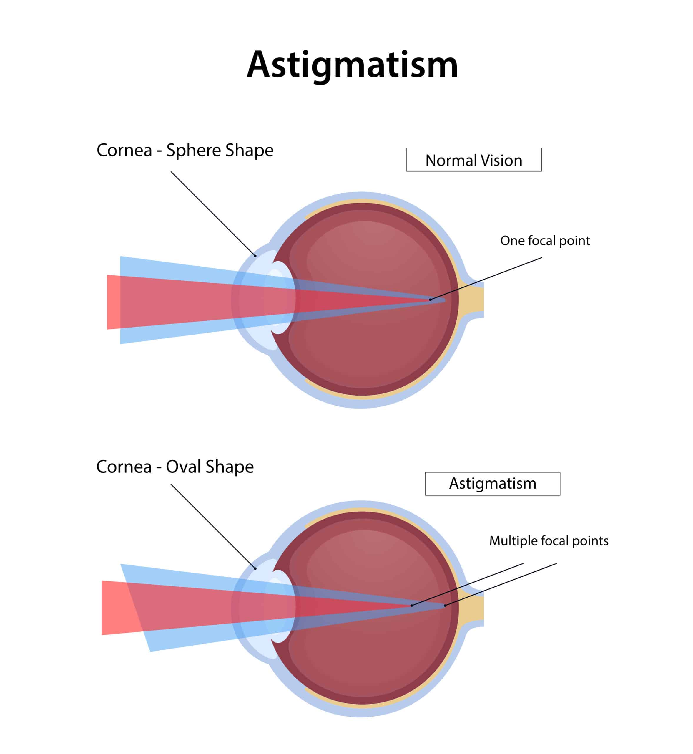 Astigmatism