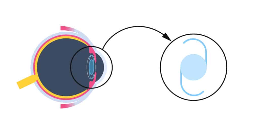 Refractive lens exchange