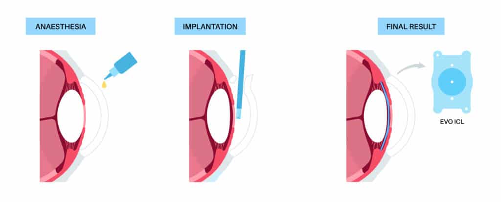 Understanding the ICL Surgery Journey