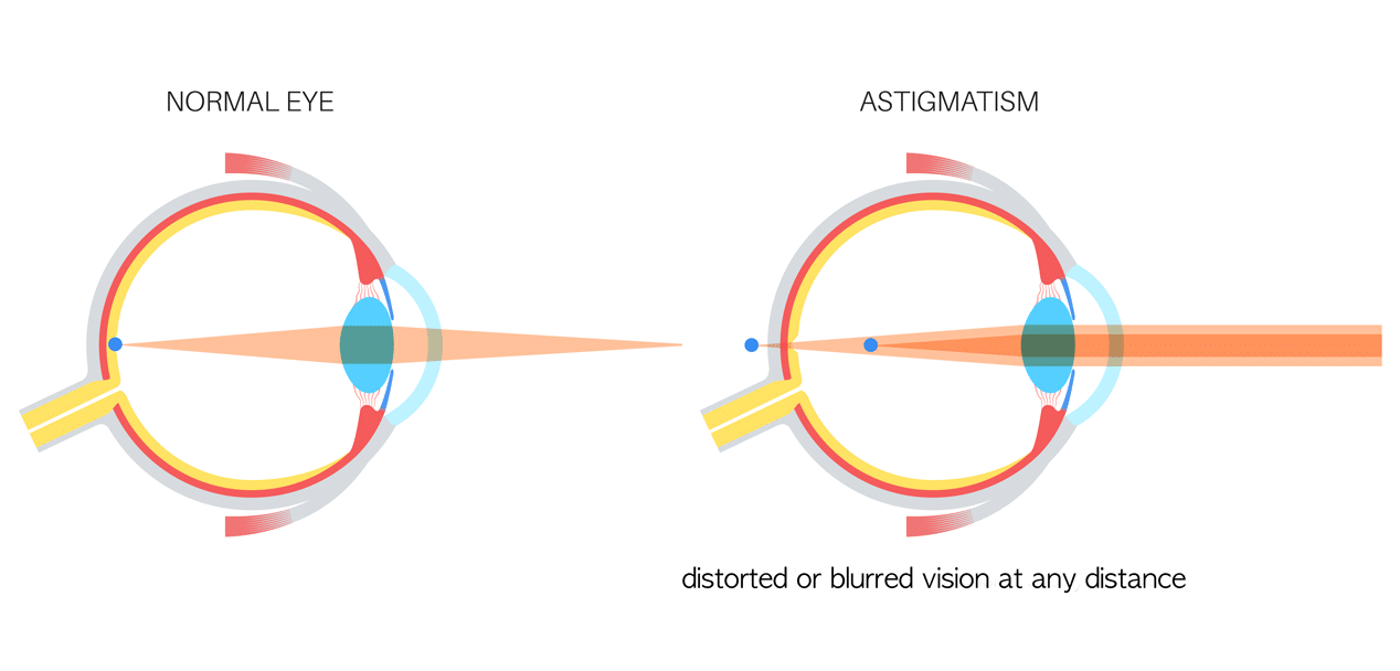 astigmatism