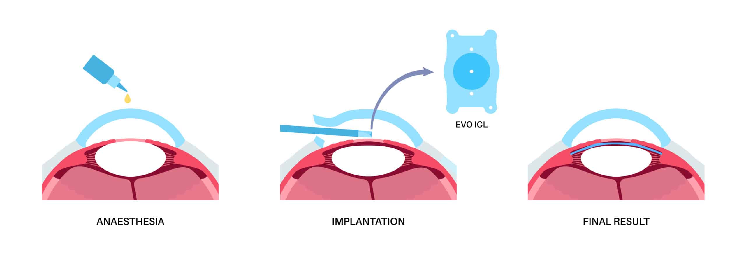 EVO ICL Surgery