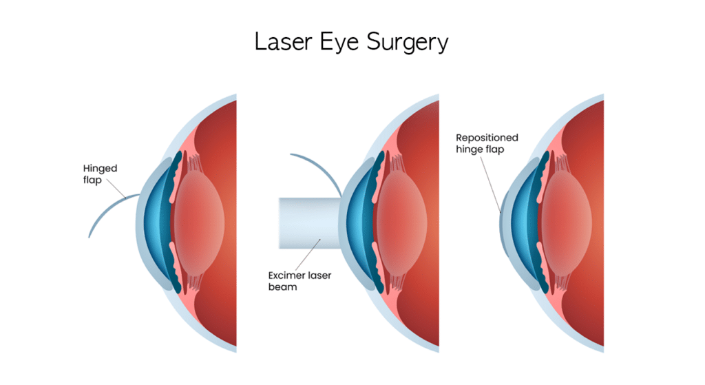 laser eye surgery
