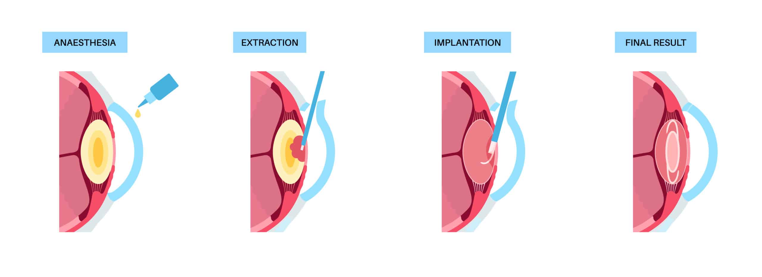 Lens Replacement Surgery
