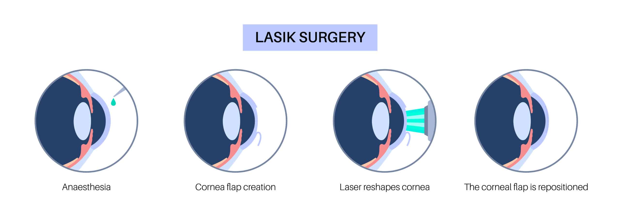 LASIK eye surgery process