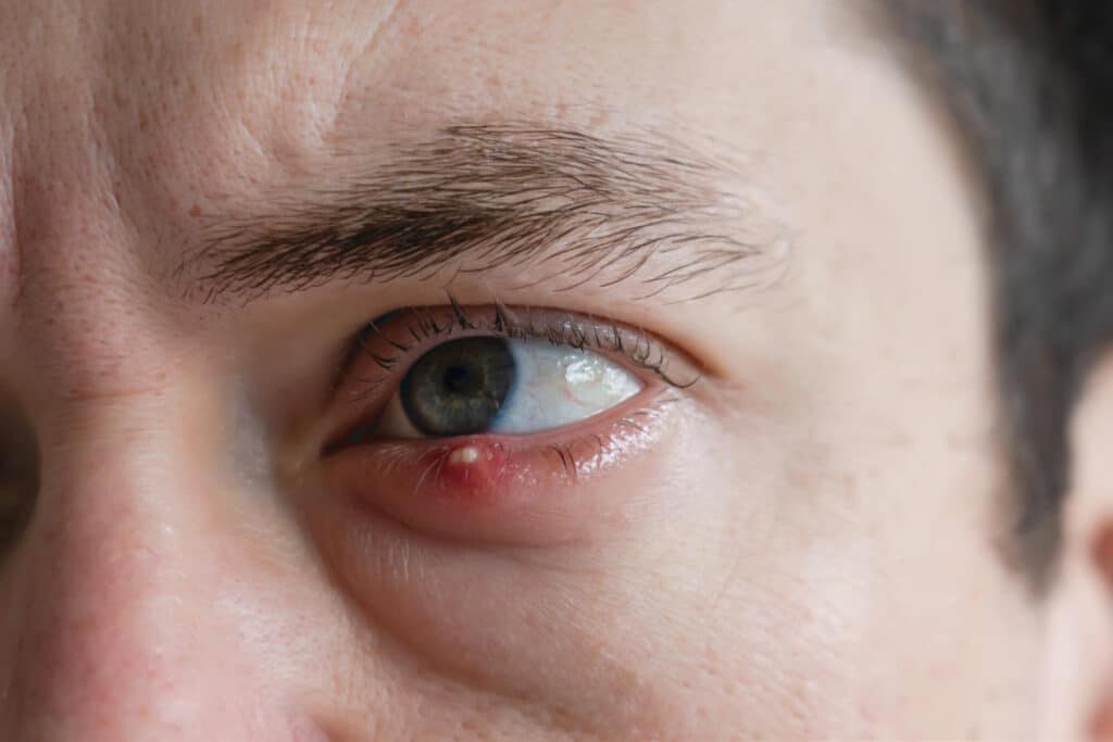 stye